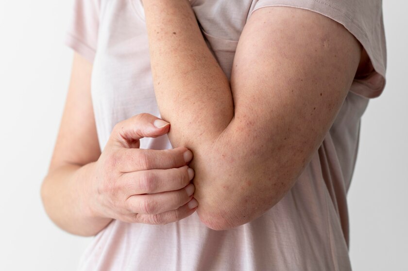 Thiếu vitamin A dễ gây bệnh ngoài da